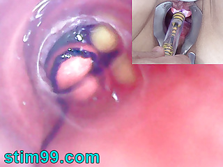 Mature Woman, Peehole Endoscope Camera in Bladder with Balls